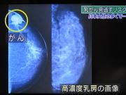 高度乳房の画像